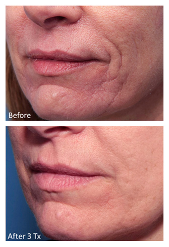 Genius RF Microneedling Before and After, DeSoto, TX