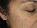 AFter Genius® Microneedling