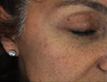 Before Genius® Microneedling