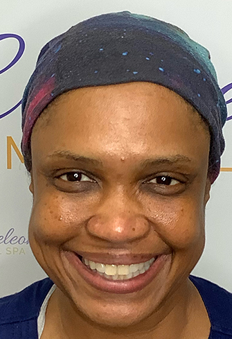 Genius RF Microneedling Before, DeSoto, TX