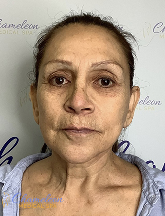 Genius RF Microneedling Before, DeSoto, TX