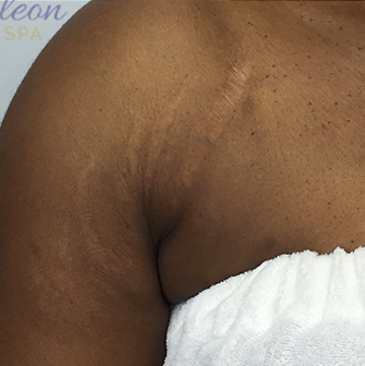 Genius RF Microneedling After, DeSoto, TX