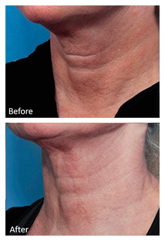 Genius RF Microneedling Before and After, DeSoto, TX