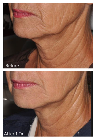 Genius RF Microneedling Before and After, DeSoto, TX