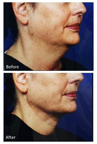 Genius RF Microneedling Before and After, DeSoto, TX