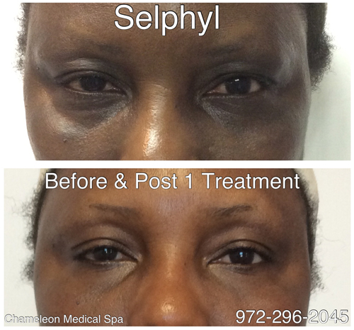 Selphyl® Before and After, DeSoto, TX