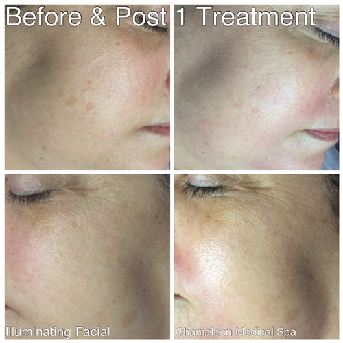 Illuminating Facial Before and After, DeSoto, TX