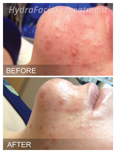 HydraFacial® Before and After, DeSoto, TX