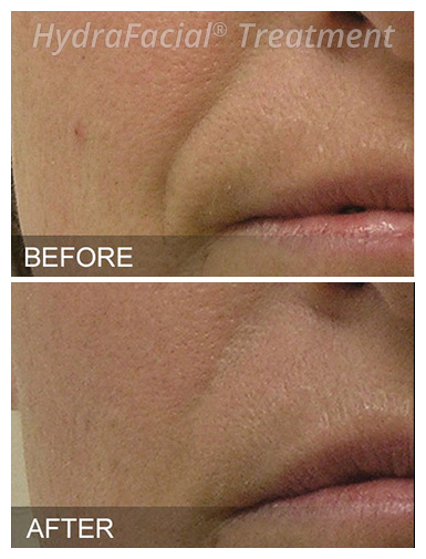 HydraFacial® Before and After, DeSoto, TX