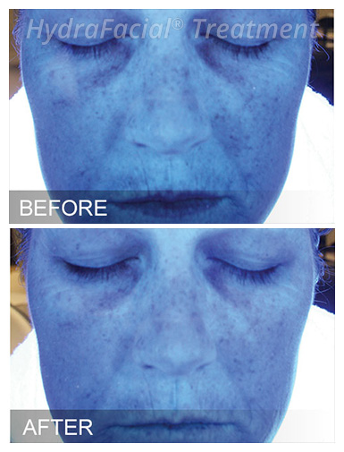 HydraFacial® Before and After, DeSoto, TX