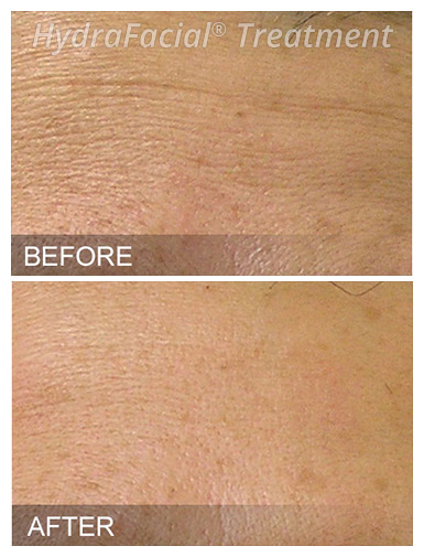 HydraFacial® Before and After, DeSoto, TX