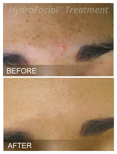 HydraFacial® Before and After, DeSoto, TX