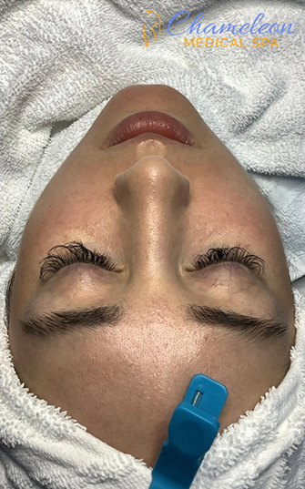 HydraFacial® Before, DeSoto, TX