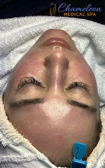 HydraFacial® Before, DeSoto, TX