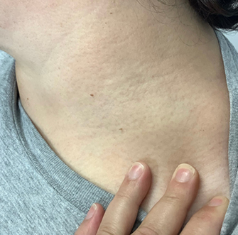 Skin Tags Removal Before, DeSoto, TX