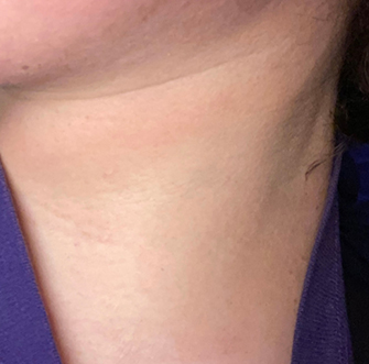 Skin Tags Removal Before, DeSoto, TX