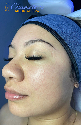 HydraFacial® Before, DeSoto, TX