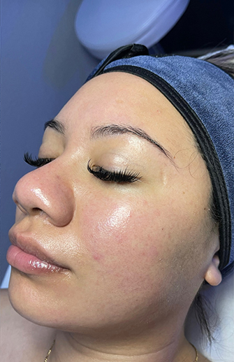 HydraFacial® Before, DeSoto, TX