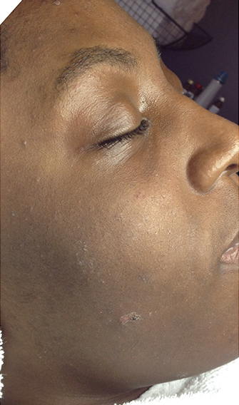 HydraFacial® Before, DeSoto, TX