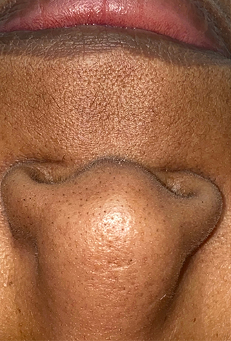 HydraFacial® Before, DeSoto, TX