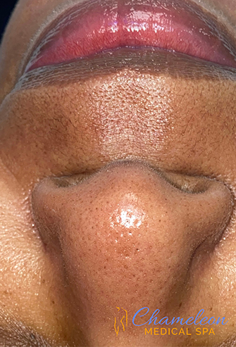 HydraFacial® After, DeSoto, TX