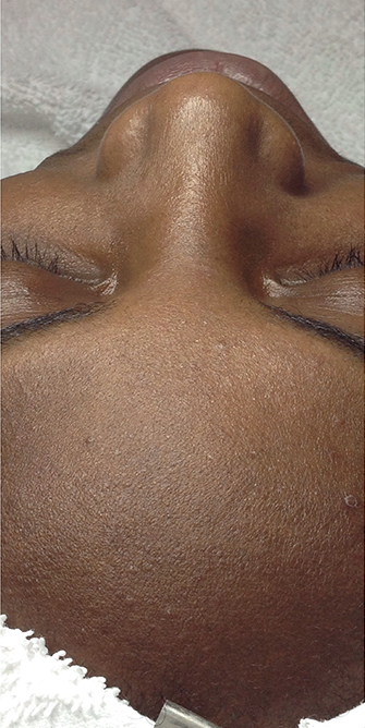 HydraFacial® Before, DeSoto, TX