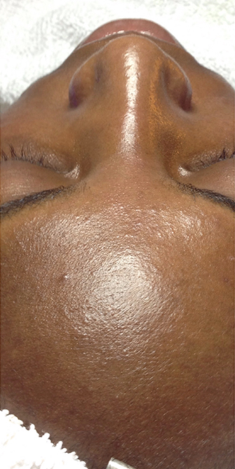 HydraFacial® After, DeSoto, TX